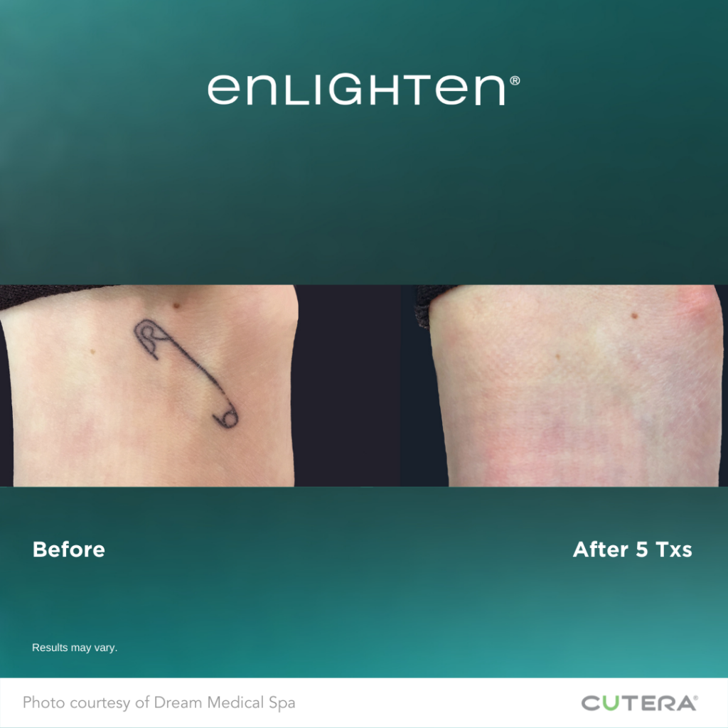 A week after first laser session! Using Cutera Enlighten laser. Will post  before in comments! : r/TattooRemoval