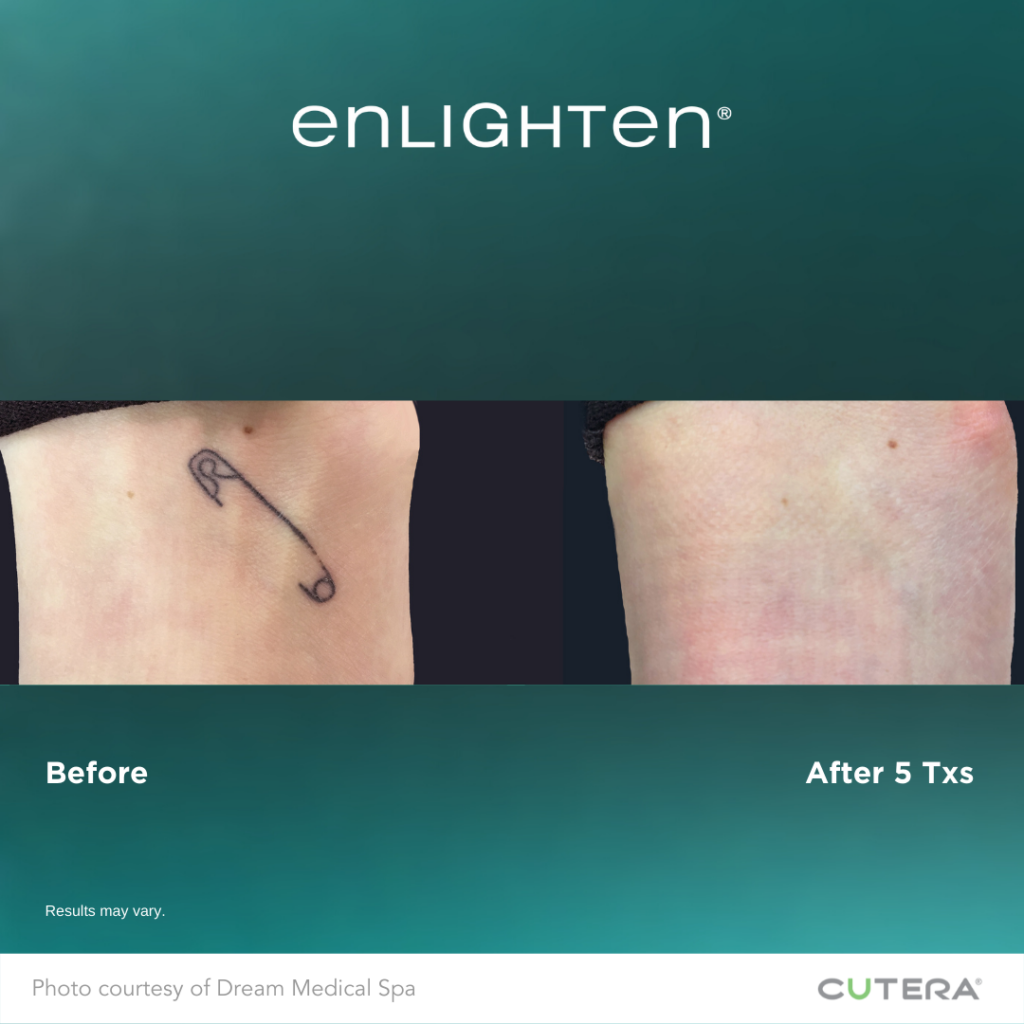 Enlighten® III for Tattoo Removal Rejuvenations Laser Center