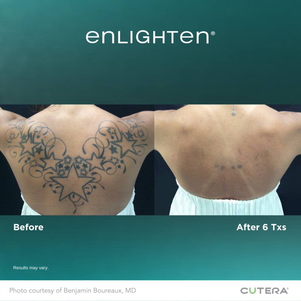 Tattoo Removal by Surgery | Care Well Medical Centre