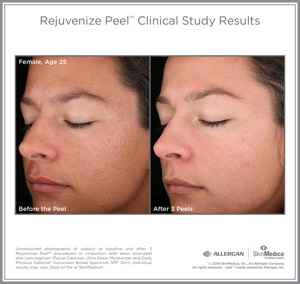 How Often Should You Get a Chemical Peel? - Rejuve Med-Spa