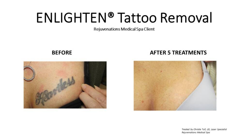 PicoWay Laser Tattoo Removal | PotozkinMD Skin Care and Laser Center